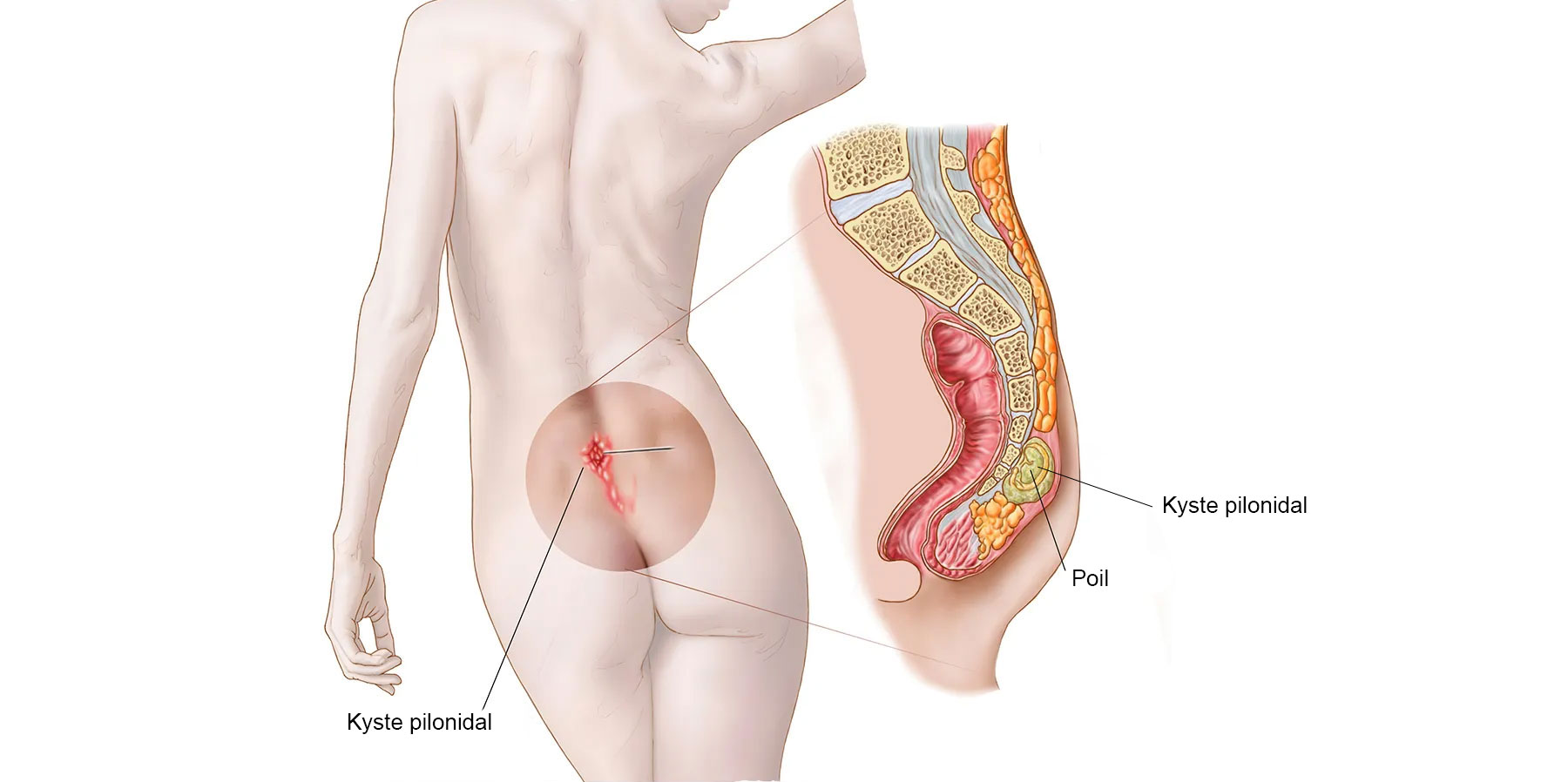 1800x1200_pilonidal_cysts_symptoms_and_treatment_bigbead.jpg